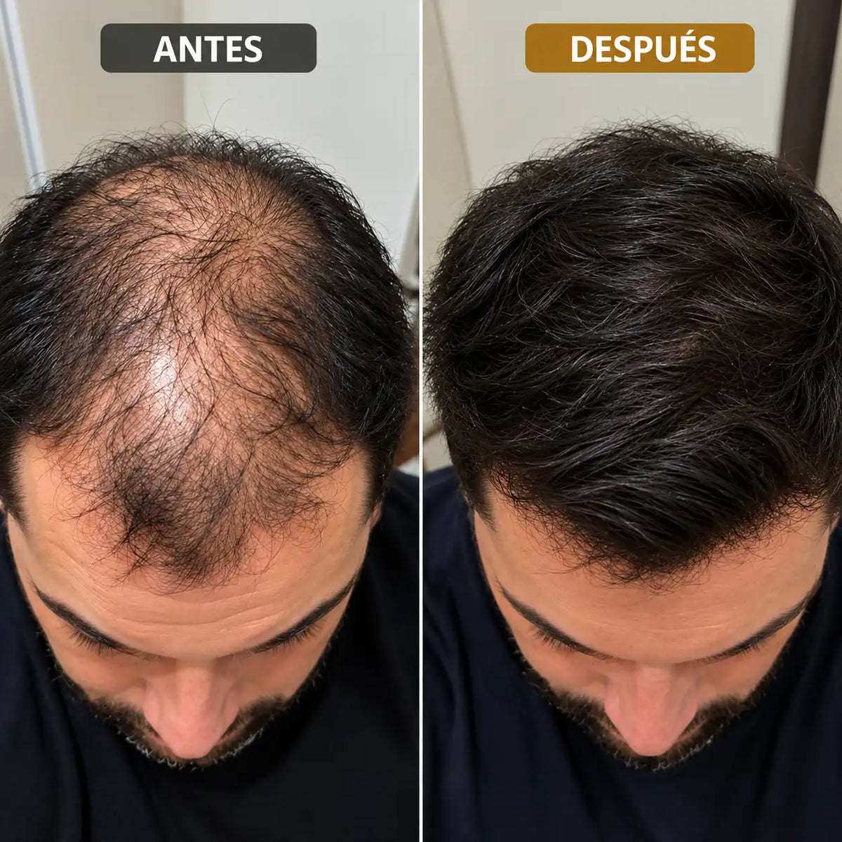 Kit sérum+Dermarroller : Barba Más Tupida y Crecimiento Capilar, Verás Resultados En 30 Dias.